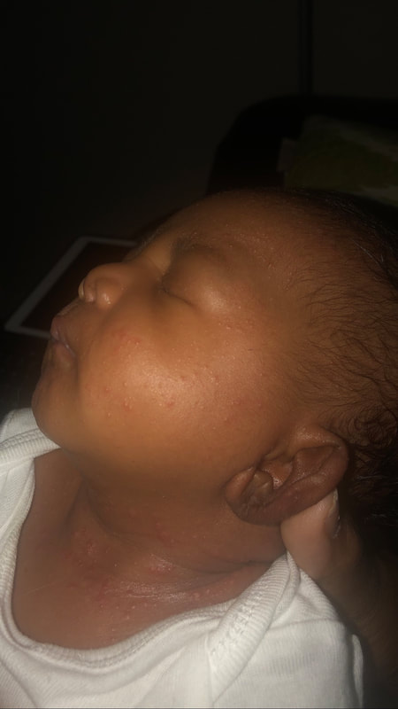 Infant Eczema face body Burdock Root