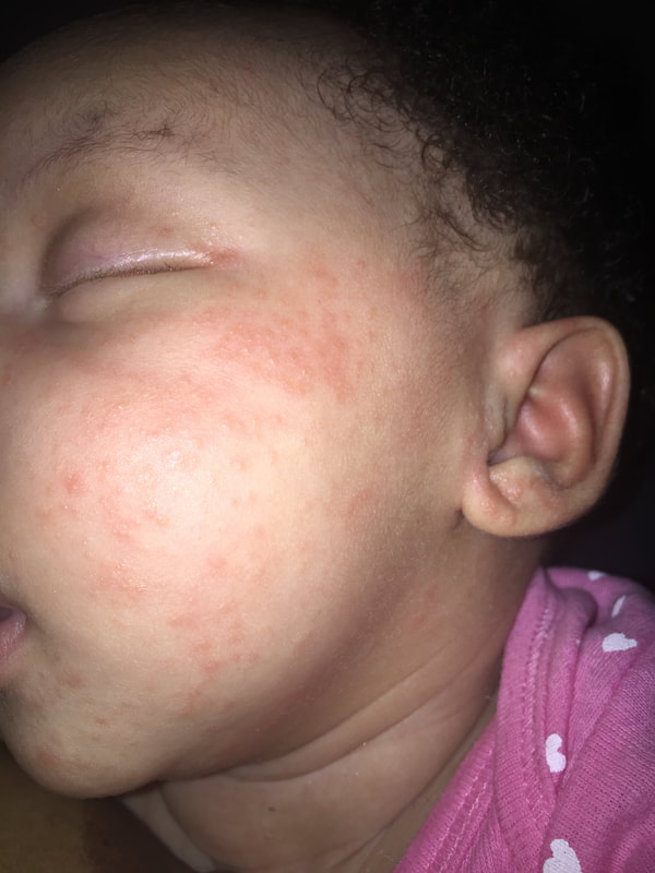 Infant Eczema face body before Nelaj Sky Burdock Root